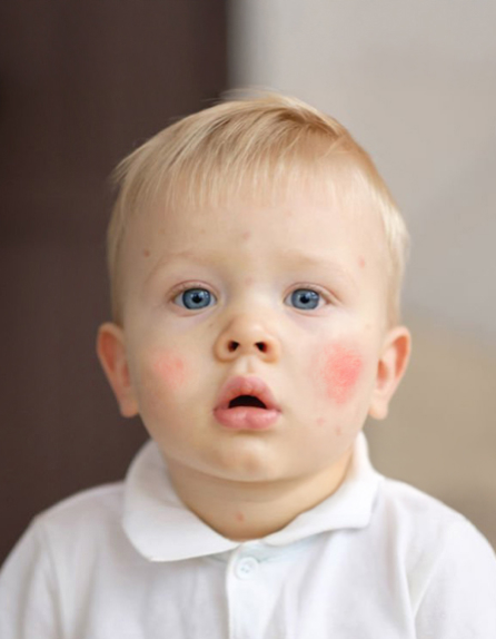 alergil-kid-2